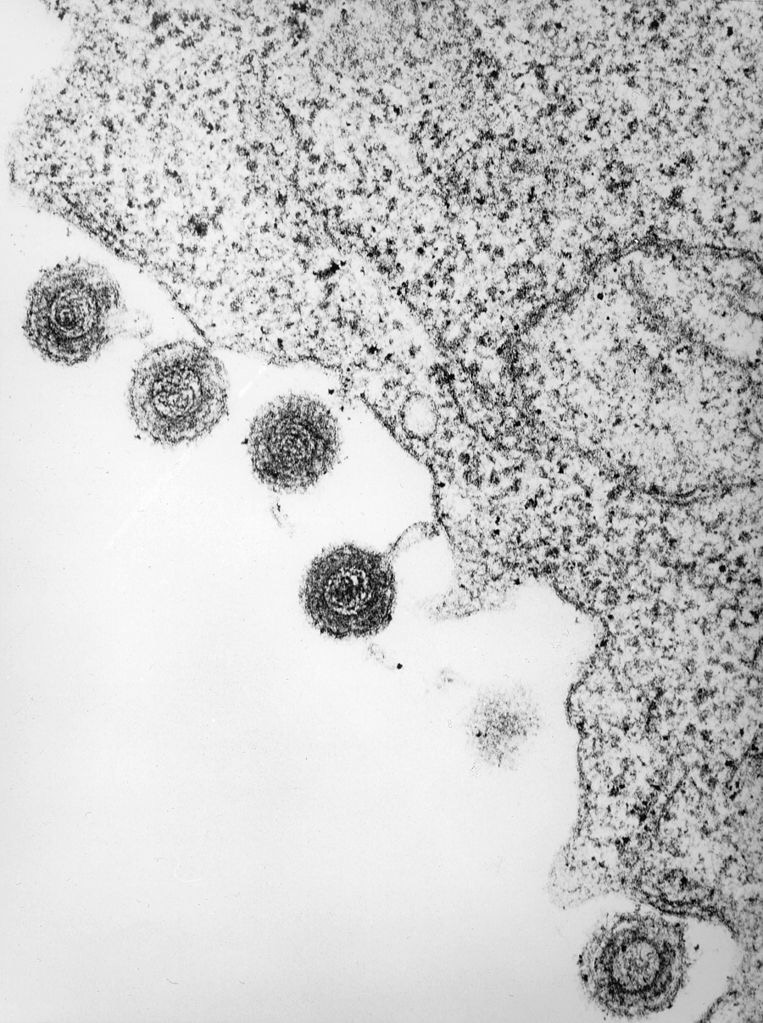 Common virus may play role in multiple sclerosis 