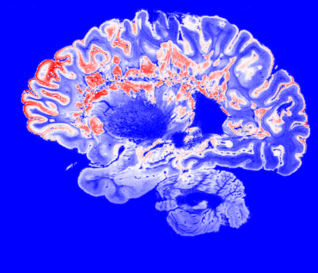 Researchers take step toward identifying free Will in the brain