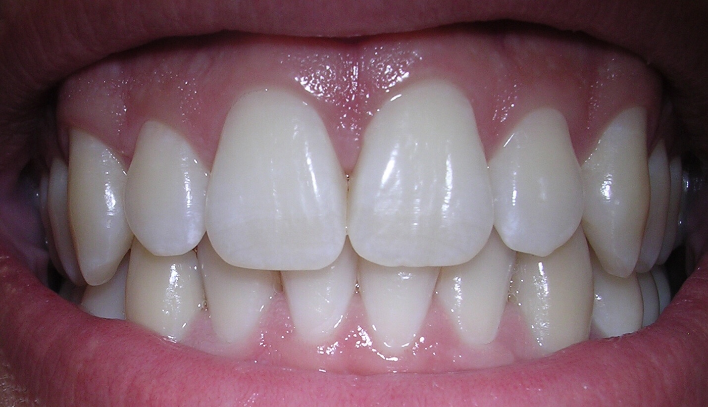 A better way to whiter teeth?