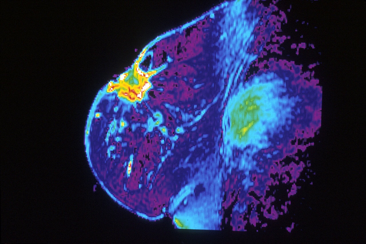 New breast cancer drug shows promise in large phase III clinical trial