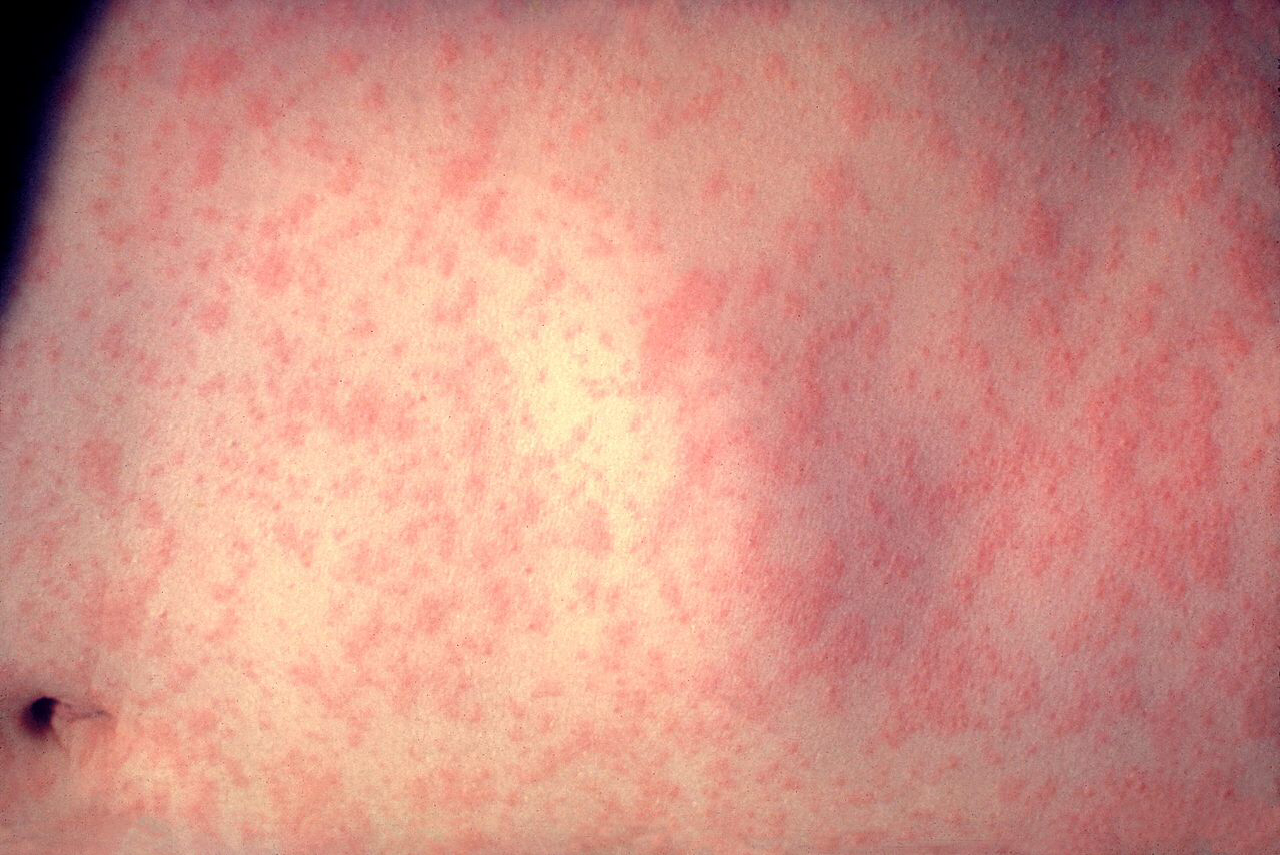SCINQ Daily News Report: Measles outbreaks spreading worldwide