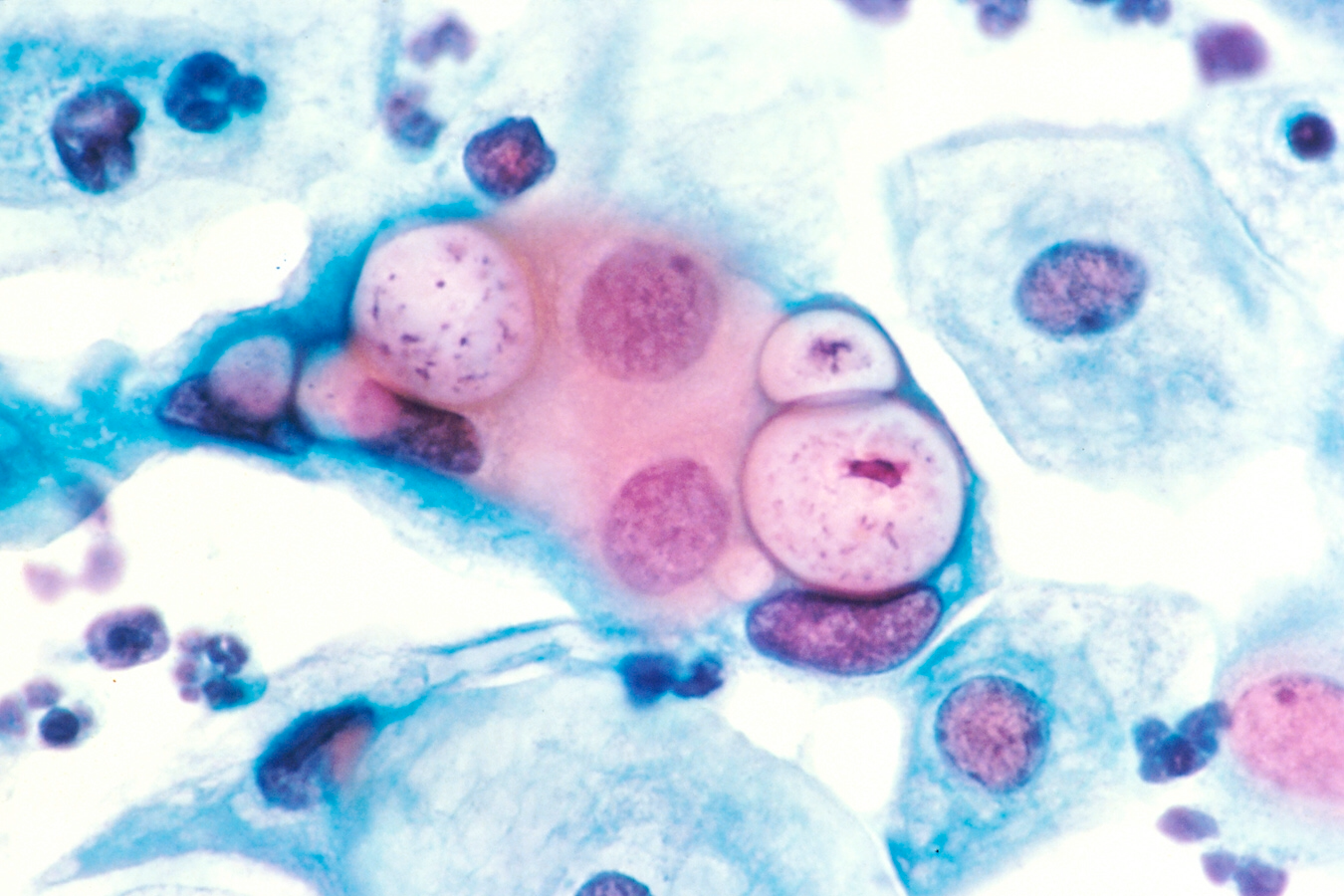A single protein allows Chlamydia to hijack human cells