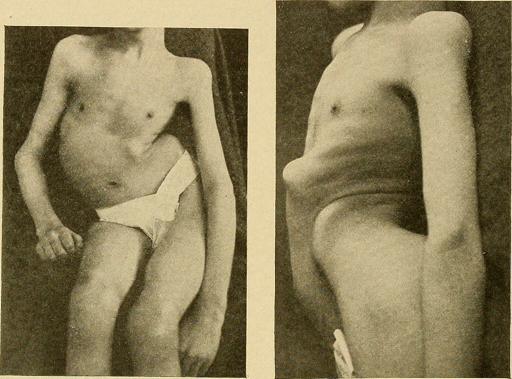 The Daily Dose: Public Health officials are starting to worry polio again