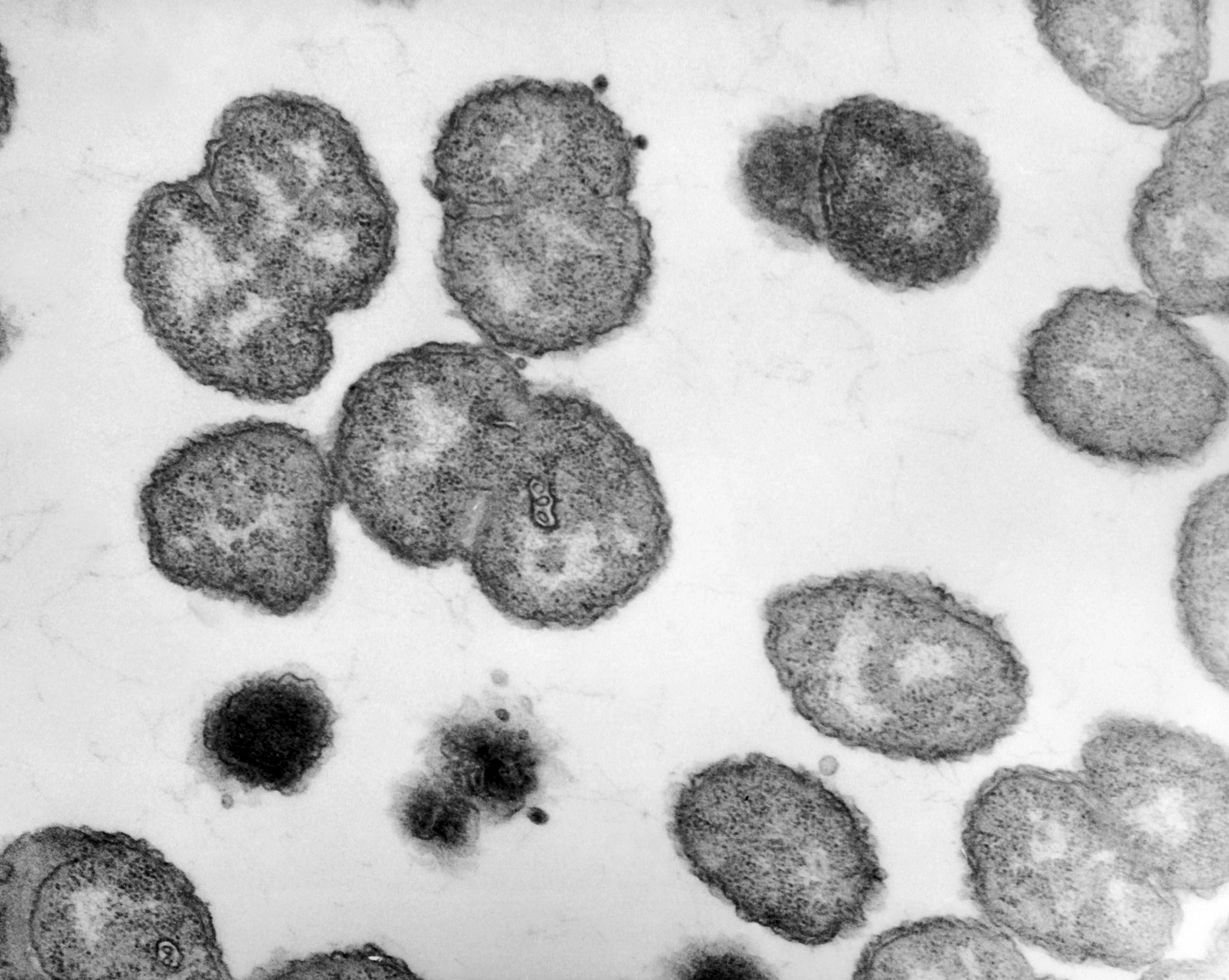 Gonorrhea on the rise in Europe