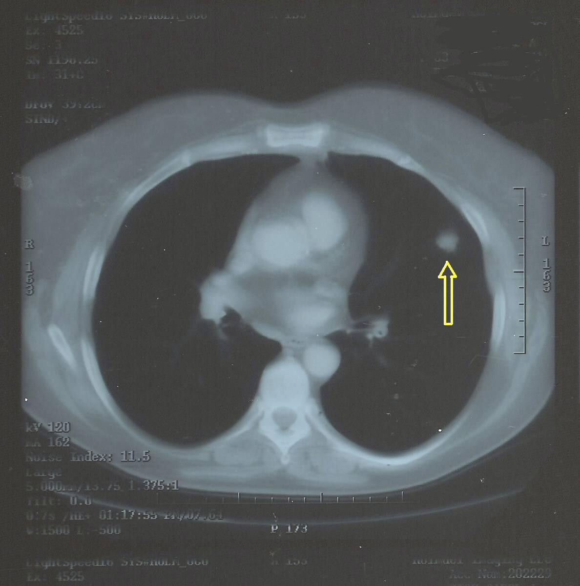 Deep learning outperforms radiologists in spotting malignant lung cancer