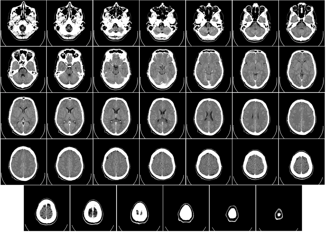 Advance made in understanding the role of amyloid in memory formation