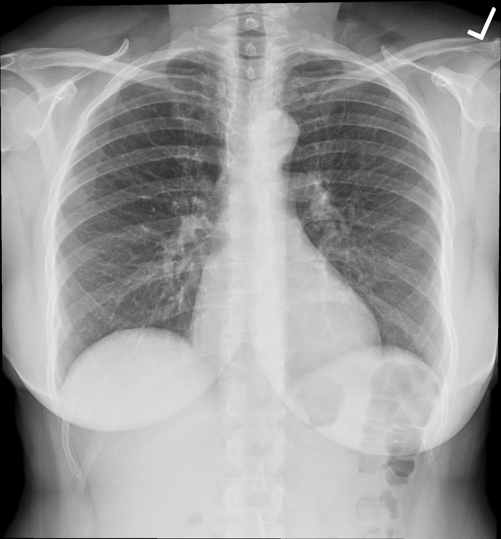 ER X-Ray of chest may hint at potential COVID-19 severity in young adults
