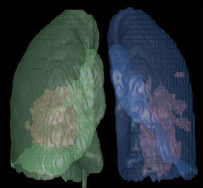 CT scans show difference between COVID-19 and influenza pneumonia