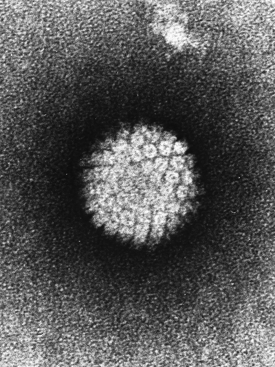 HPV may also cause prostate cancer