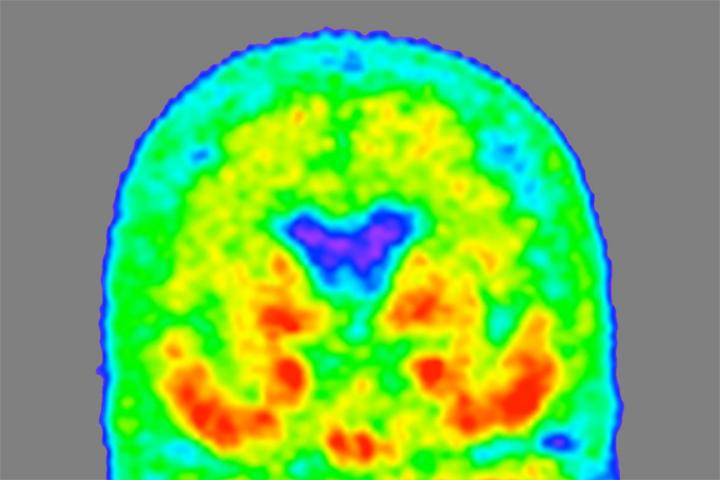 Form of Alzheimer’s protein indicates stage of disease.