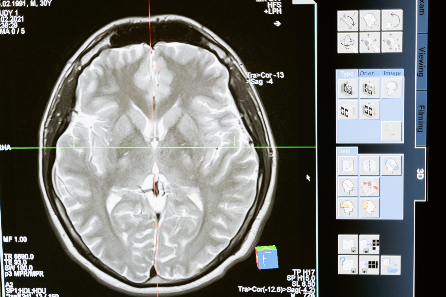 Astrocyte infection key to COVID-19 invasion of brain, study.