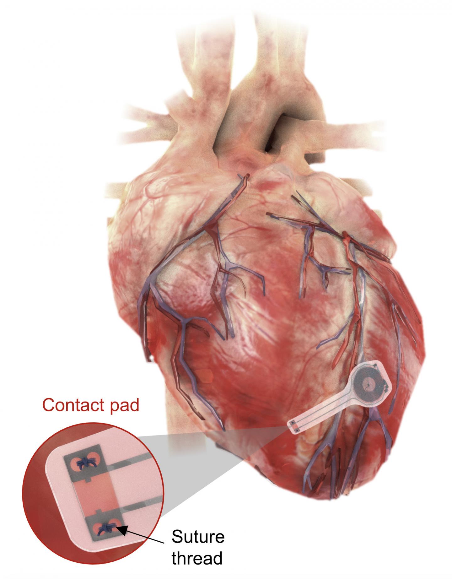 Novel wireless and battery-free pacemaker disappears when not needed.