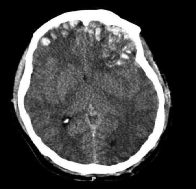 Features in CT scans can sometimes predict outcomes of brain trauma.