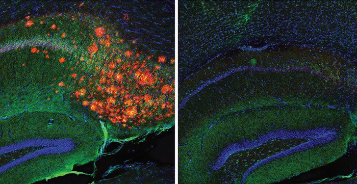 Brain cholesterol regulates Alzheimer’s plaques, study reveals.