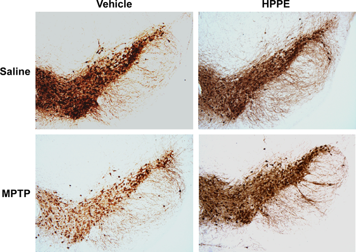 Deterioration of brain cells in Parkinson’s disease is slowed by blocking the Bach1 protein, preclinical study shows.