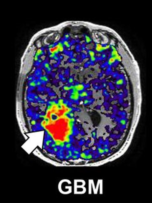 Neuroinflammation protein linked to worse survival in men with glioblastoma.