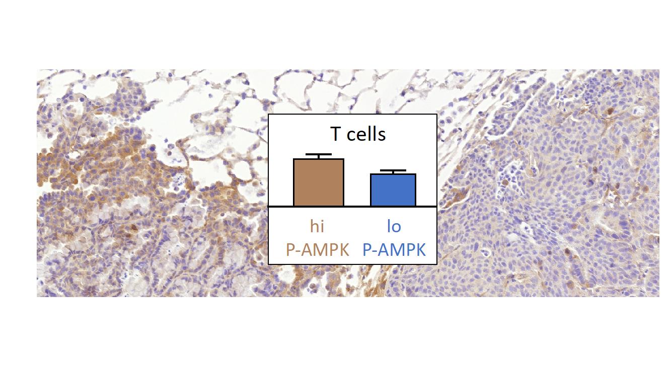Researchers identify new biomarker with potential to predict immunotherapy response in lung cancer.