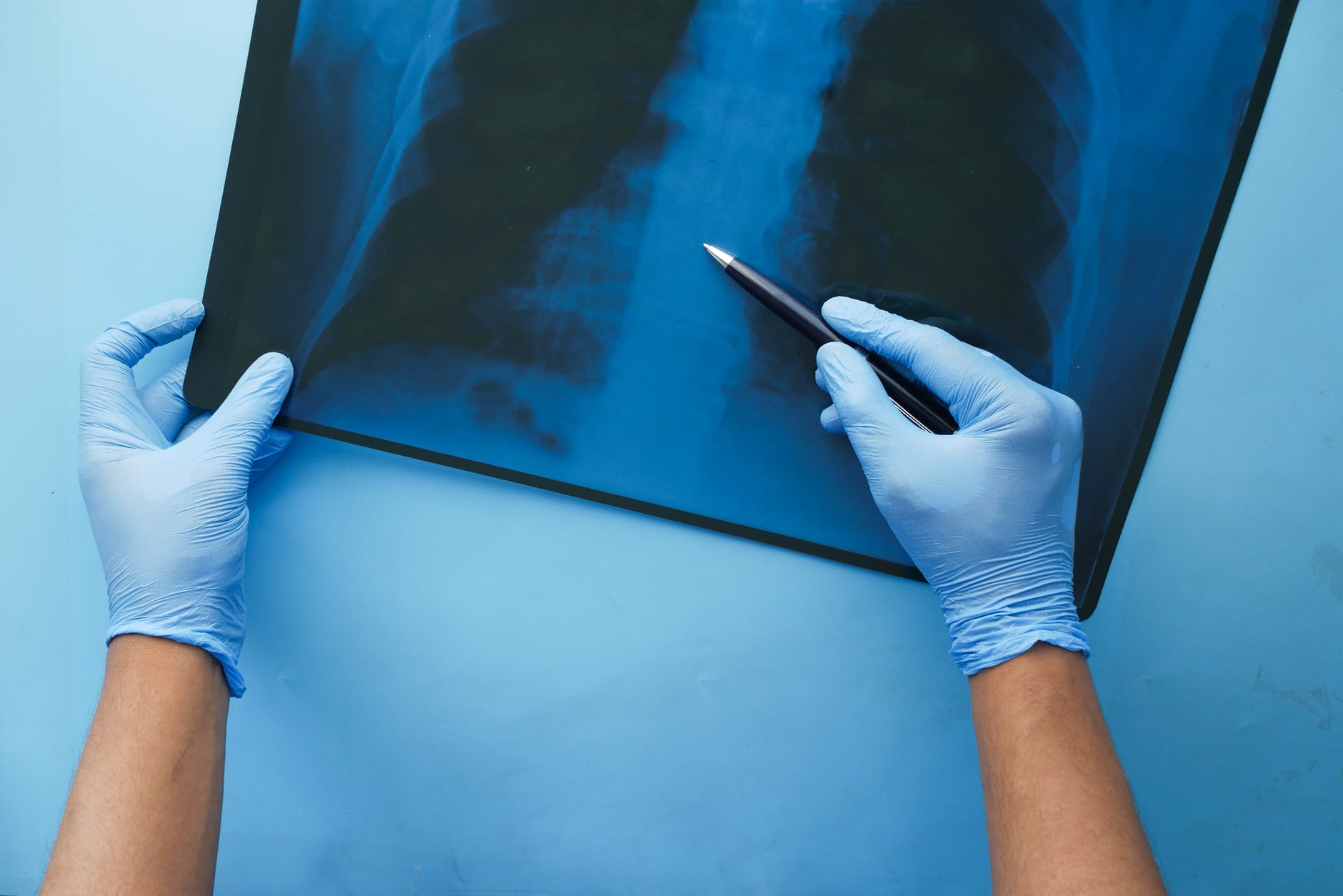 Brightest ever X-ray shows lung vessels altered by COVID-19.