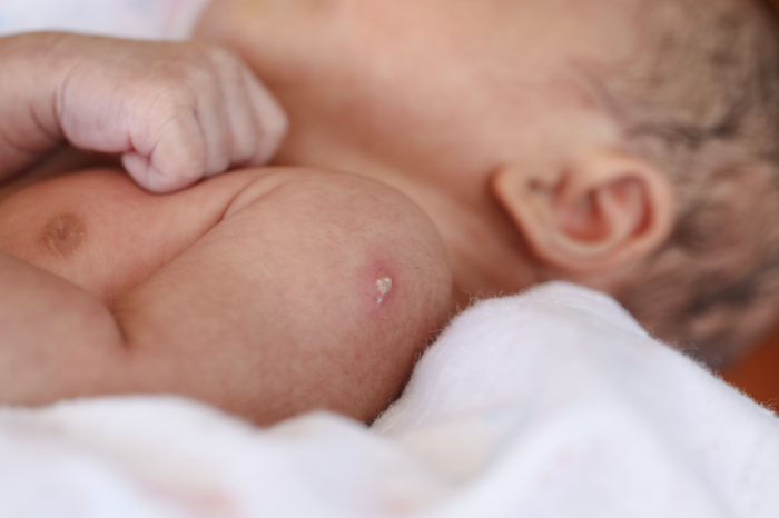 Once upon a BCG vaccine.