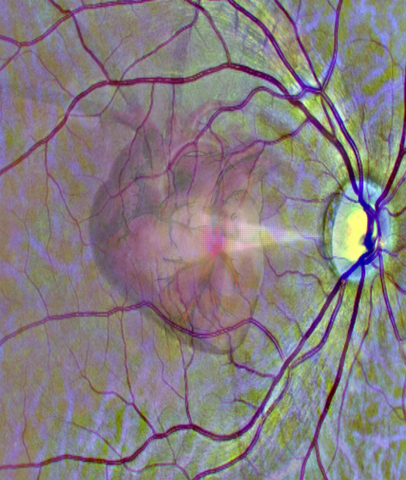 Using the eye as a window into heart disease.