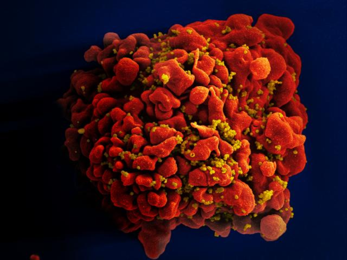 Researchers document third known case of HIV remission involving stem cell transplant.