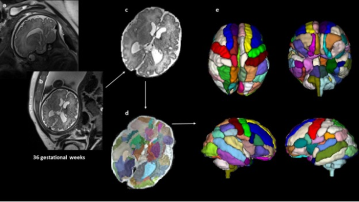 Autism-associated brain differences can be observed in the womb.