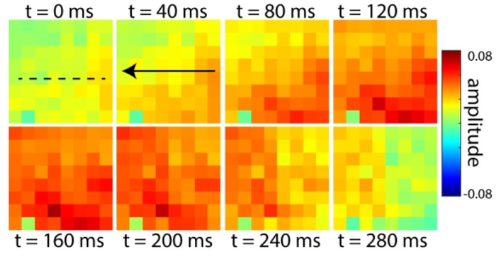 Anesthetic drastically diverts the travels of brain waves.
