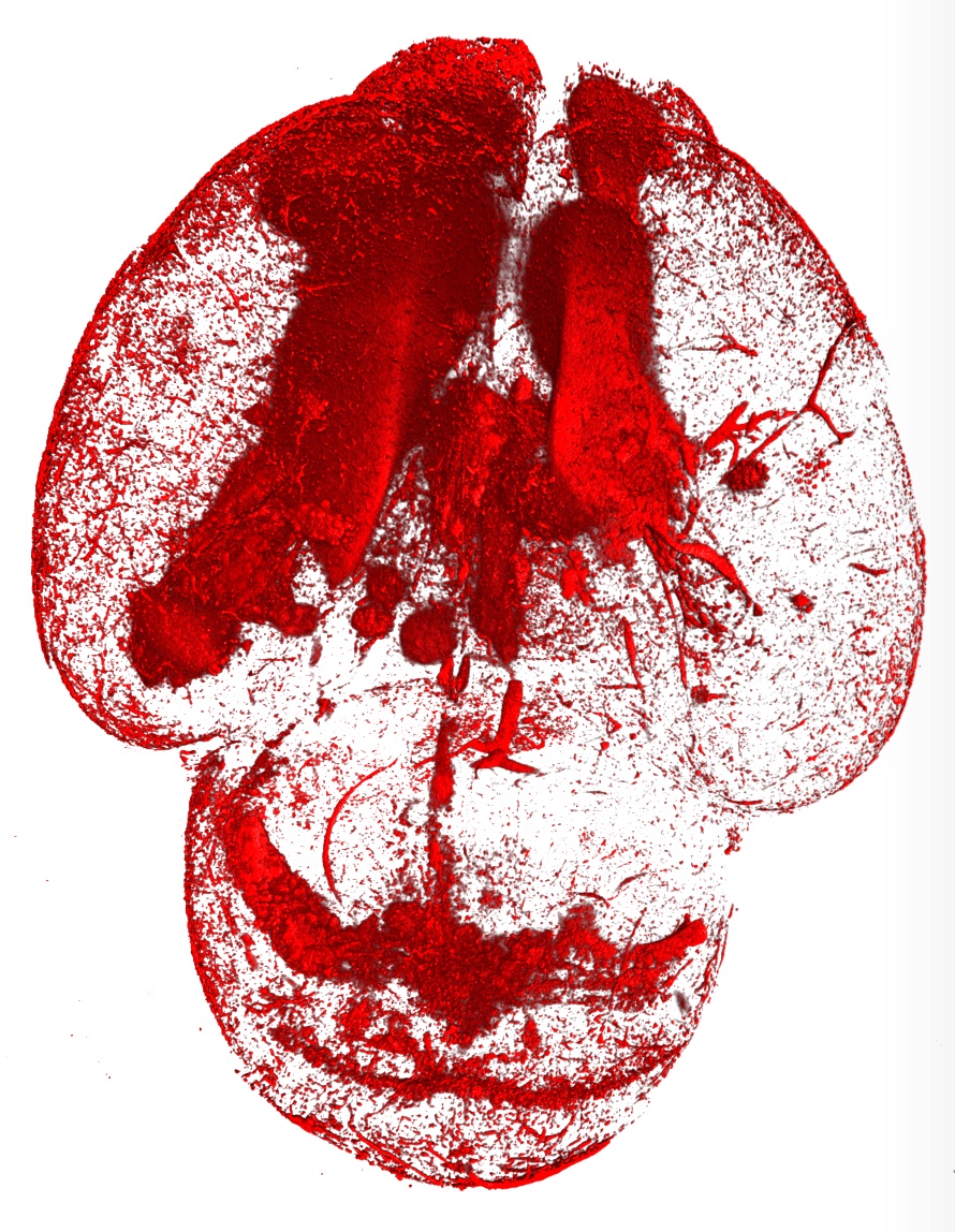 A new way of identifying babies at risk of brain bleeds.