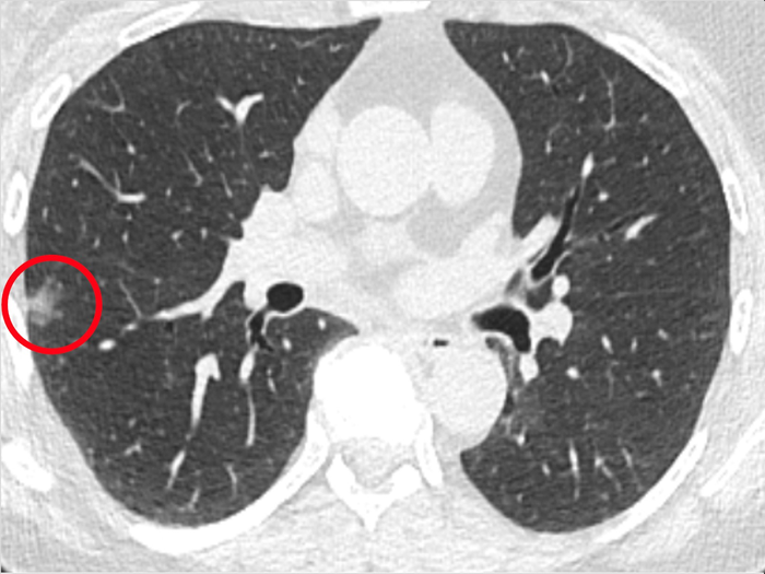 Penn Medicine study reveals imaging approach with potential to detect lung cancer earlier, at the cellular level.