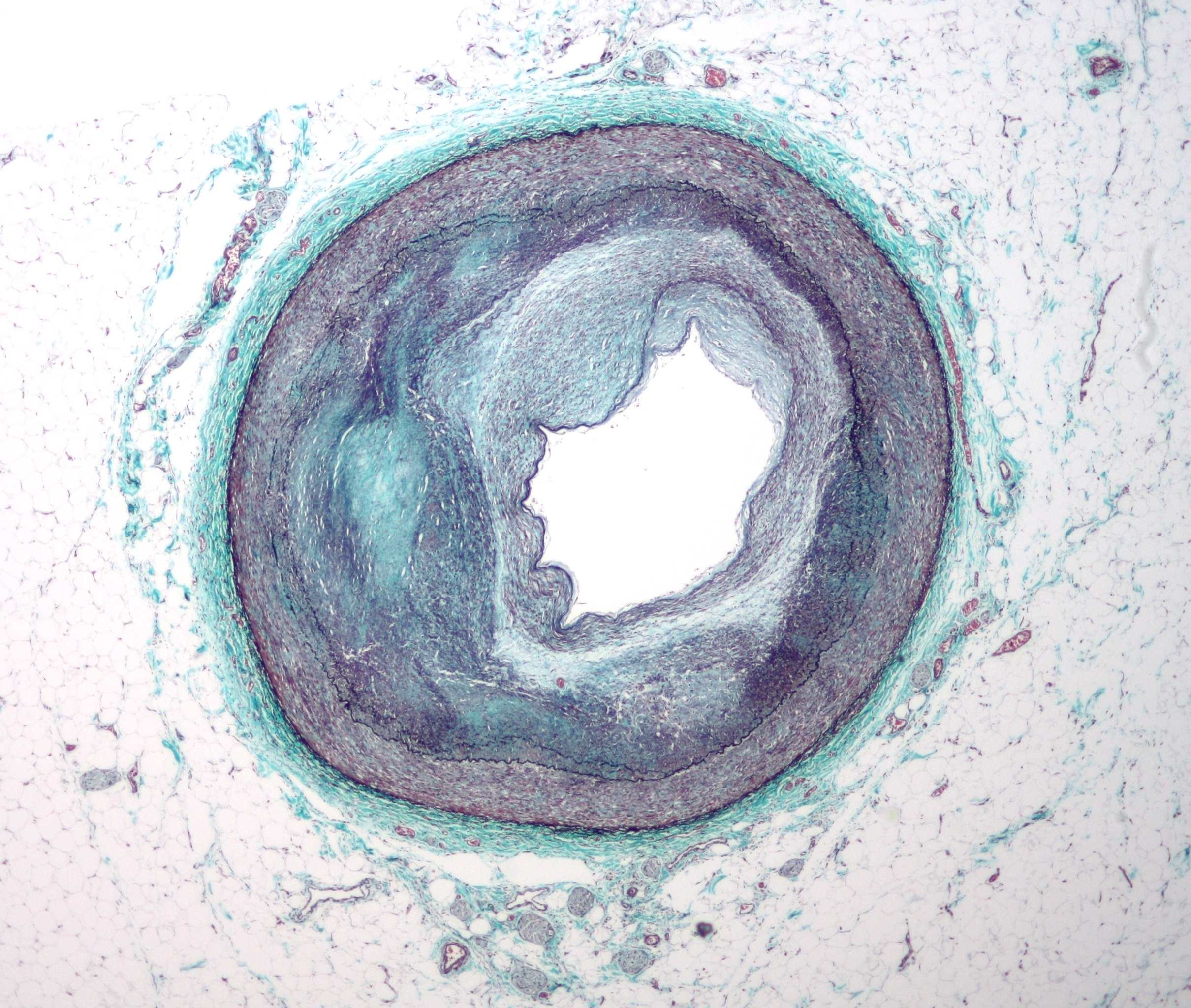 Atherosclerosis: How diseased blood vessels communicate with the brain.