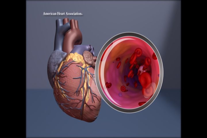 Cardiac rehab attendance lower among Asian, Black and Hispanic adults at all income levels.