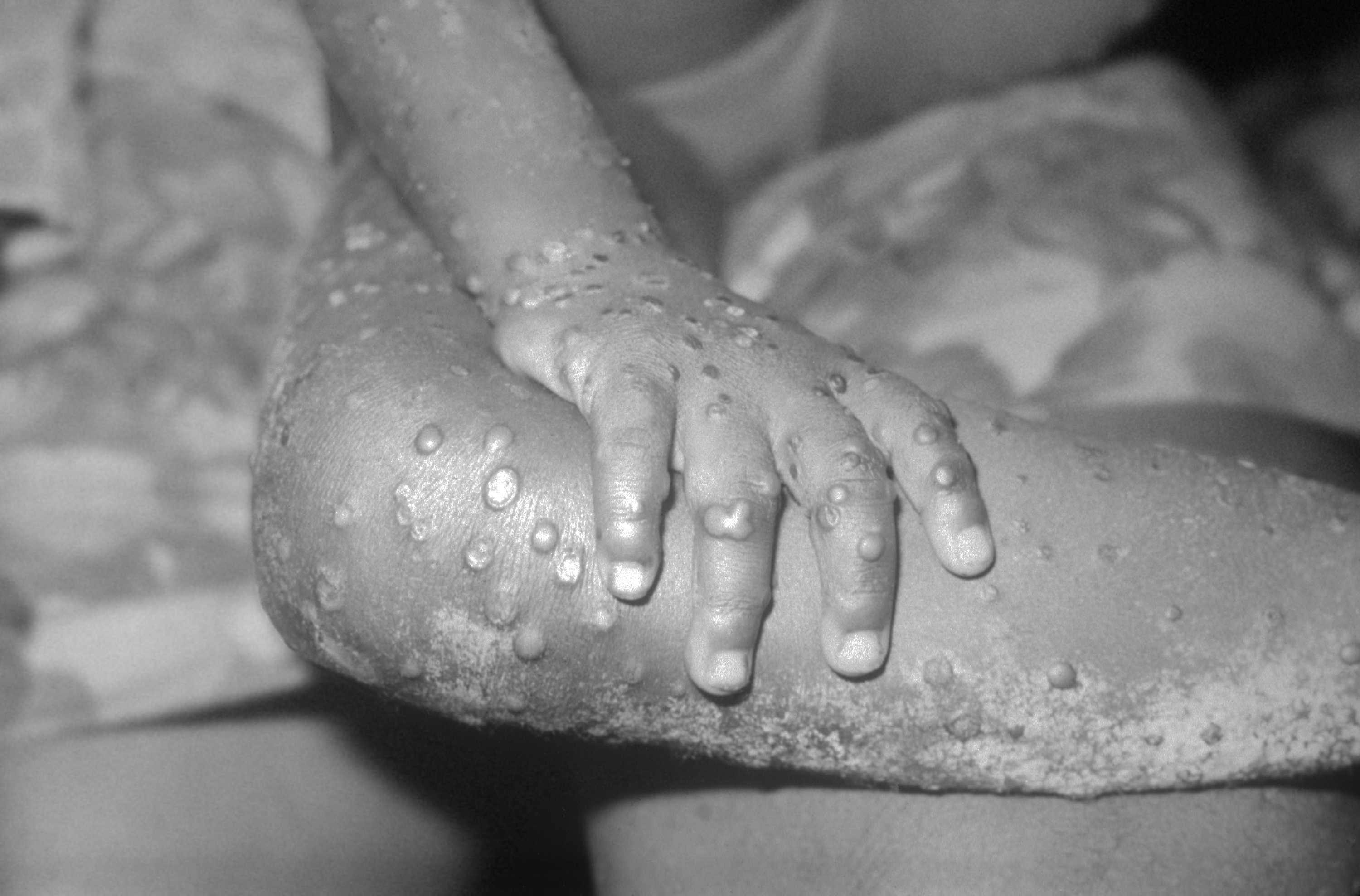 Could monkeypox affect the heart?