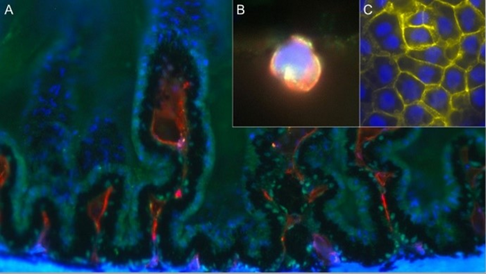 Research challenges “sugar hypothesis” of diabetic cataract development