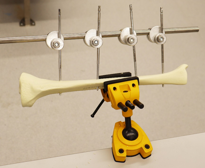 Affordable device for fixing broken bones piloted in Gaza, Sri Lanka and Ukraine