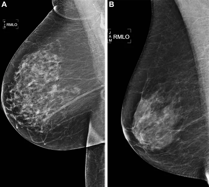 AI outperformed standard risk model for predicting breast cancer