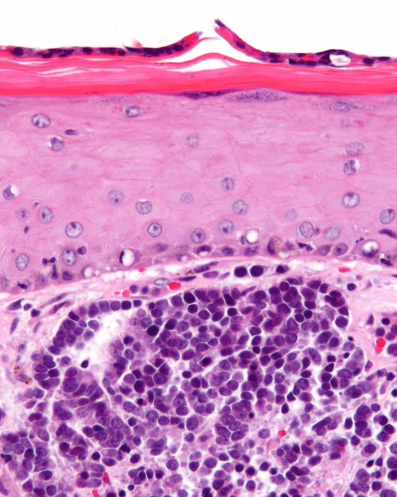 How skin cancer virus outcompetes host cell replication.