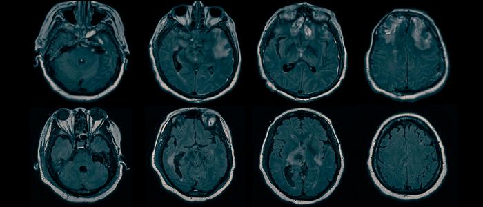 Source of hidden consciousness in ‘comatose’ brain injury patients found