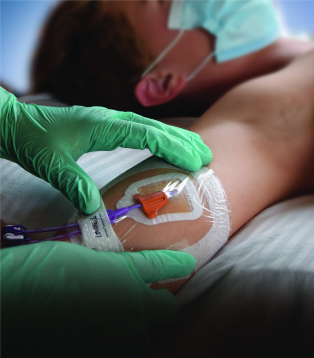 New study shows major benefits of using subcutaneous anchor securement systems to secure central vascular access devices