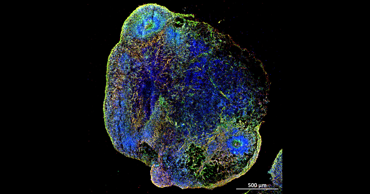 Turning back the clock on brains aged by COVID