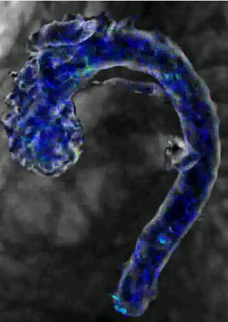 Unstable ‘fluttering’ predicts aortic aneurysm.