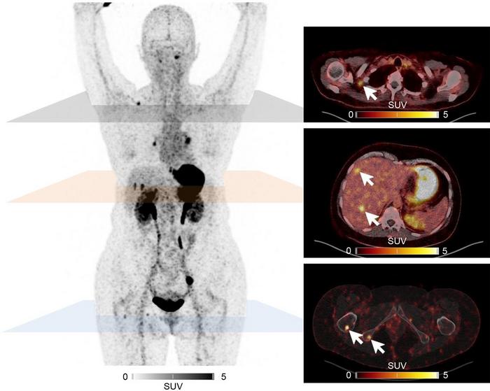Novel PET tracer enhances lesion detection in medullary thyroid cancer, offers potential for targeted therapy