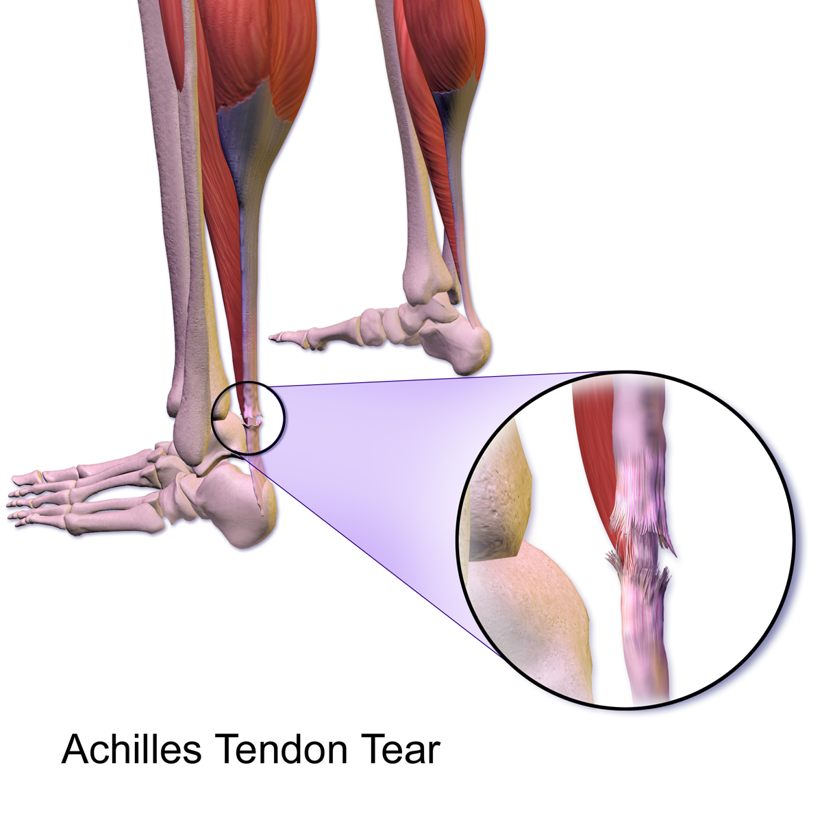 Aging-Linked Cells Emerge as Unexpected Allies in Tendon Healing