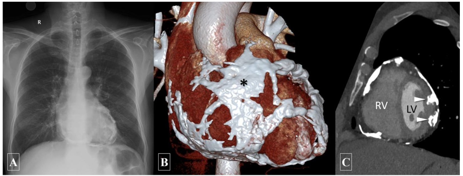 Conversations with Bruce Fouke and Mayandi Sivaguru: Exploring the Science of Heart Calcification.