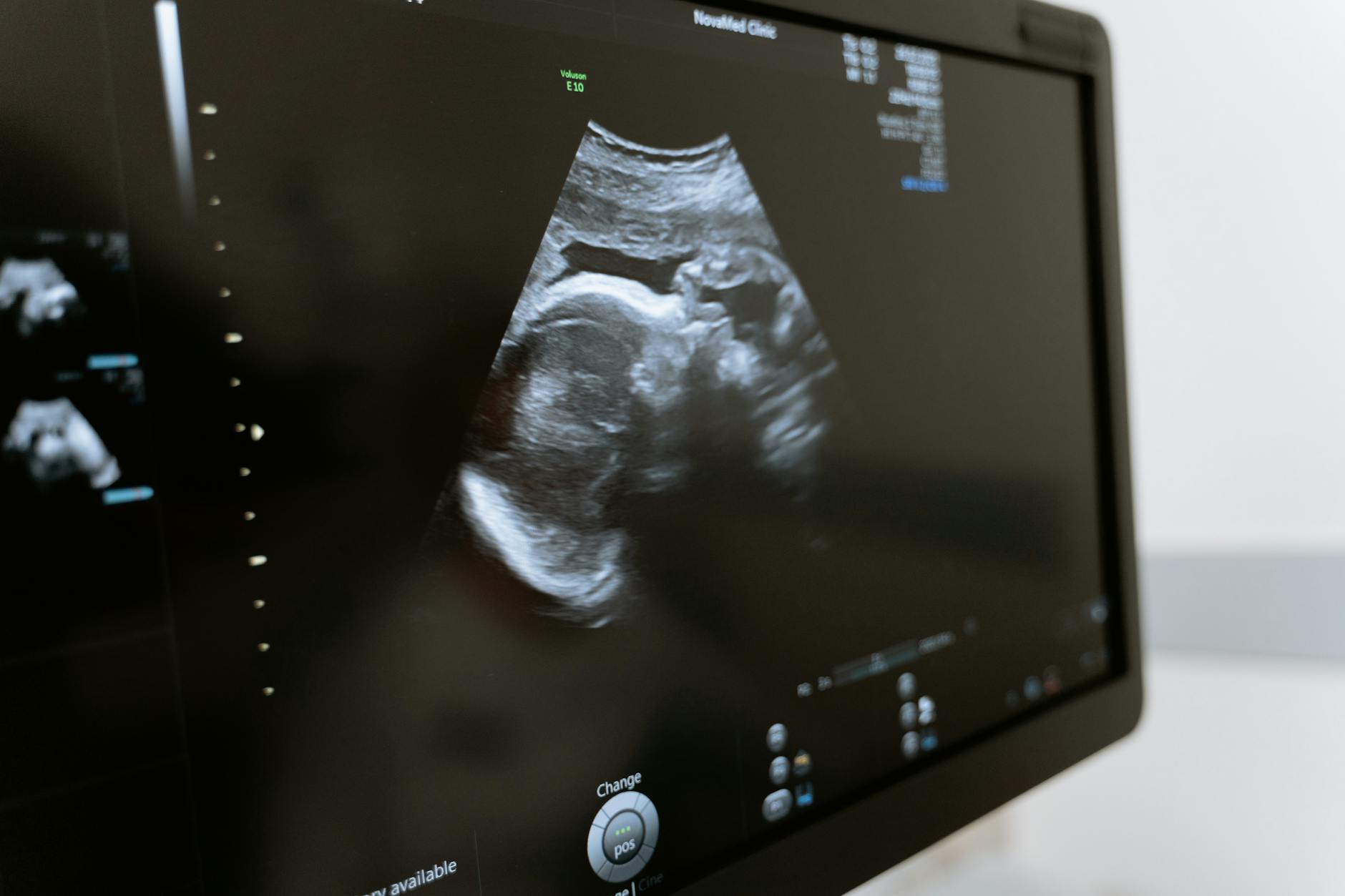 Pregnancy after sterilization turns out to be surprisingly common