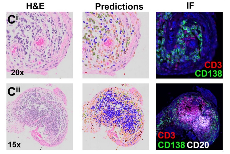 Machine learning helps identify rheumatoid arthritis subtypes