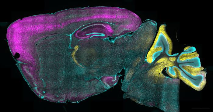 Precision DNA editing targets root cause of severe childhood epilepsy in preclinical study