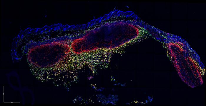 Garvan scientists capture โhousekeepingโ immune cells attacking live melanoma
